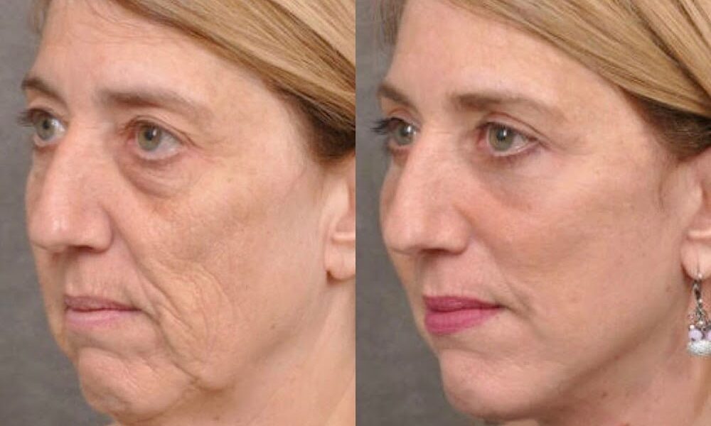 Lilly Beauty Medical Spa | Facial | EMsculpt | Laser hair removal