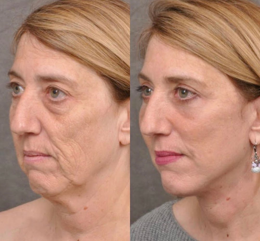 Lilly Beauty Medical Spa | Facial | EMsculpt | Laser hair removal